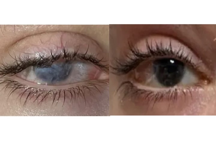 Foto del ojo del paciente tratado (dcha) y sin tratar (izqda)