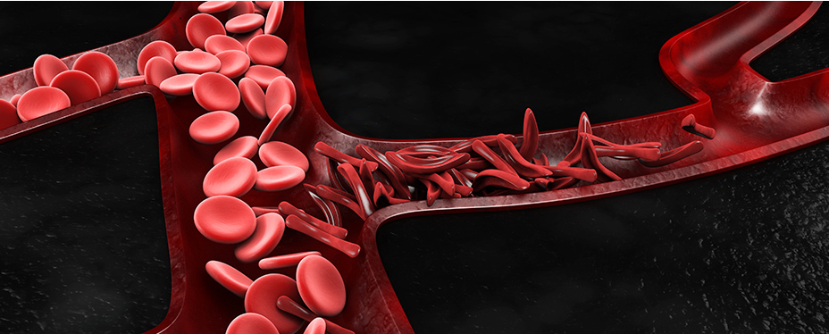 Dibujo que ilustra lo glóbulos rojos normales (en forma de disco) y los glóbulos rojos característicos de la anemia falciforme (en forma de cayado, que suelen taponar vasos sanguíneos y provocar accidentes vasculares)