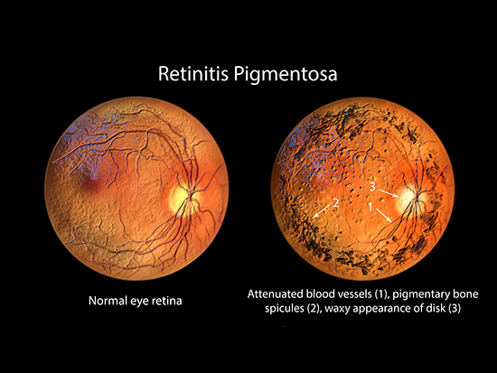 ALG6 actúa como un gen modificador en la enfermedad ocular genética hereditaria retinosis pigmentaria 59