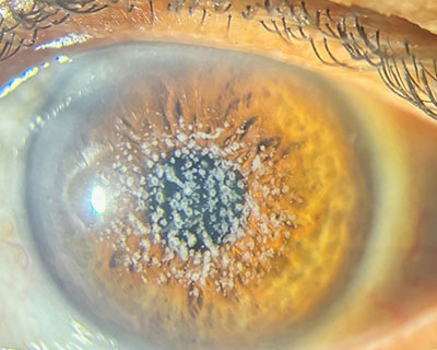 Distrofia corneal de Reis-Bücklers