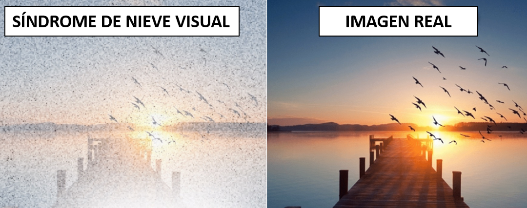 Síndrome de la nieve visual: Alteraciones en el procesamiento cerebral de la visión