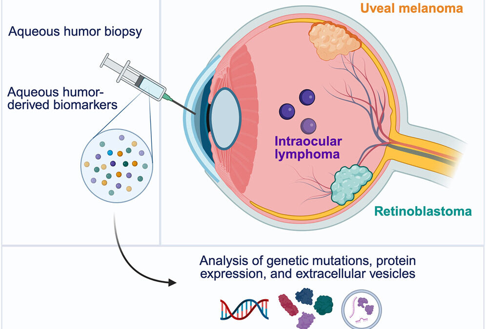 👁️ Un nuevo avance en el estudio de los tumores oculares